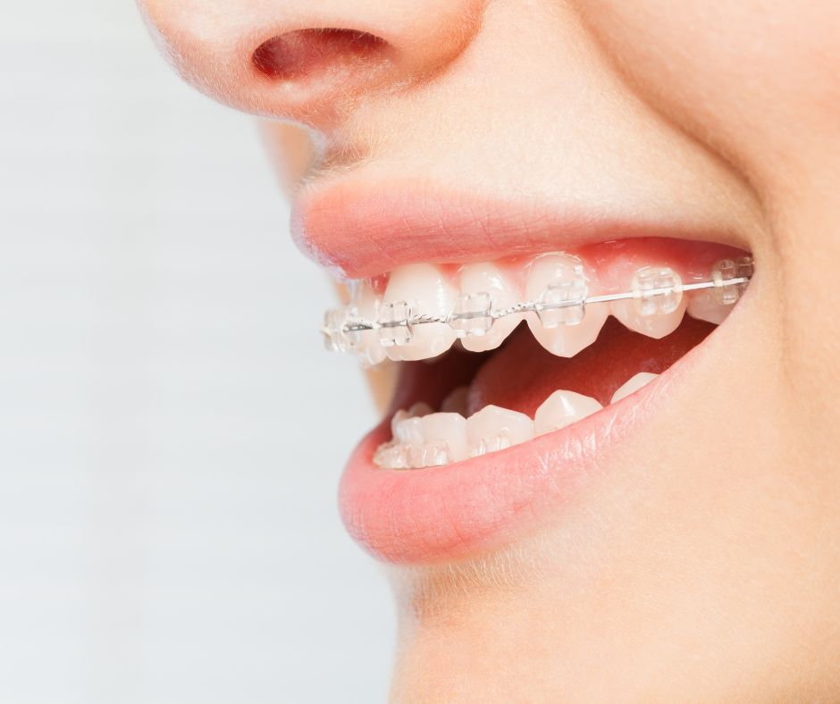 clarity braces