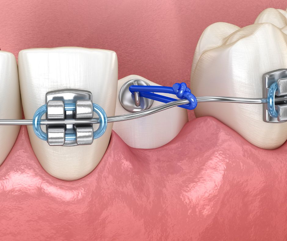 ortho elastics