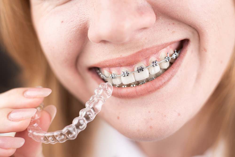 Braces and Invisalign